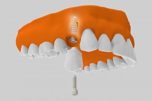 implantes dentales arriba