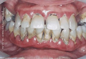 problemas periodontales dental clinic